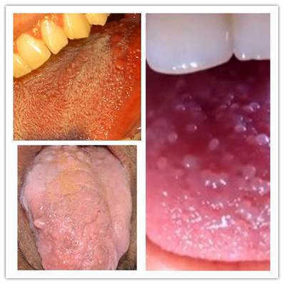 enlarged tongue papillae treatment