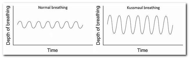 Kussmaul Respirations vs Normal Breathing