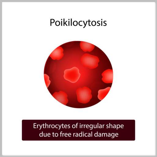 Poikilocytosis Definition
