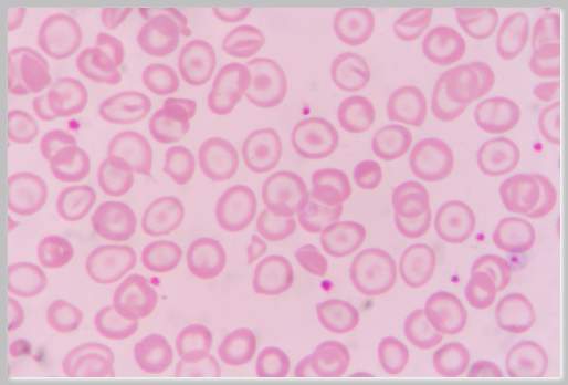 Causes of Poikilocytosis