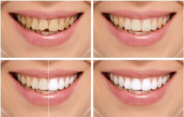 how to whiten teeth at home with hydrogen peroxide
