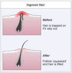 How to Get Rid of Ingrown Pubic Hair 