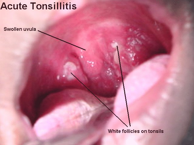 White Blisters Throat