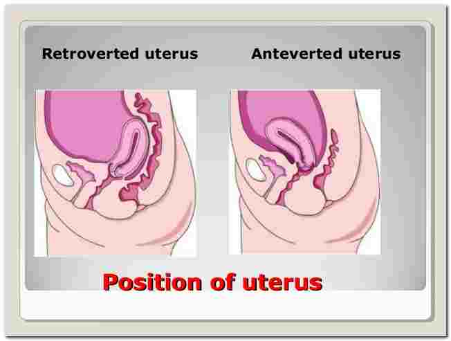 Uterus early pregnancy and tilted Retroverted (Tilted,Tipped)